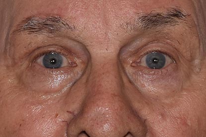 Brow Lift Before & After Photo