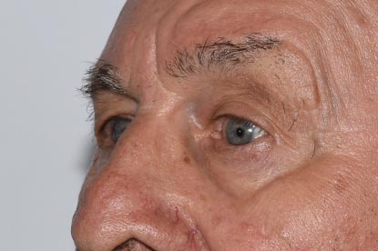Brow Lift Before & After Image