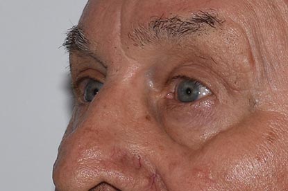 Brow Lift Before & After Image