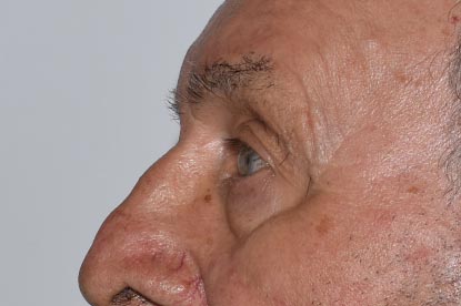 Brow Lift Before & After Image