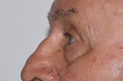 Brow Lift Before & After Image