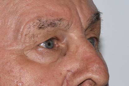 Brow Lift Before & After Image