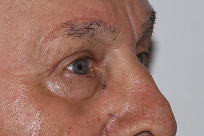 Brow Lift Before & After Image