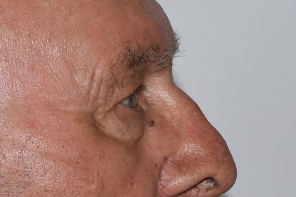 Brow Lift Before & After Image