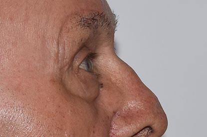 Brow Lift Before & After Image