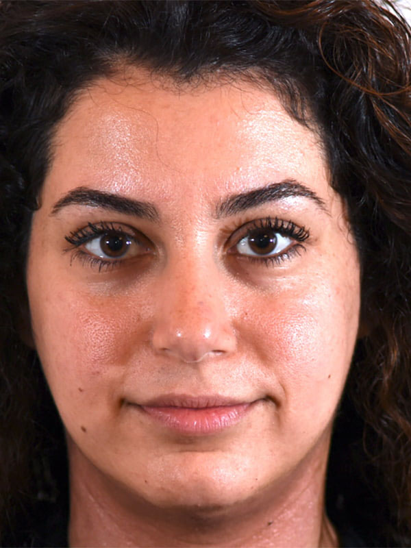 Buccal Fat Removal Before & After Photo