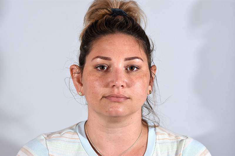 Buccal Fat Removal Before & After Photo