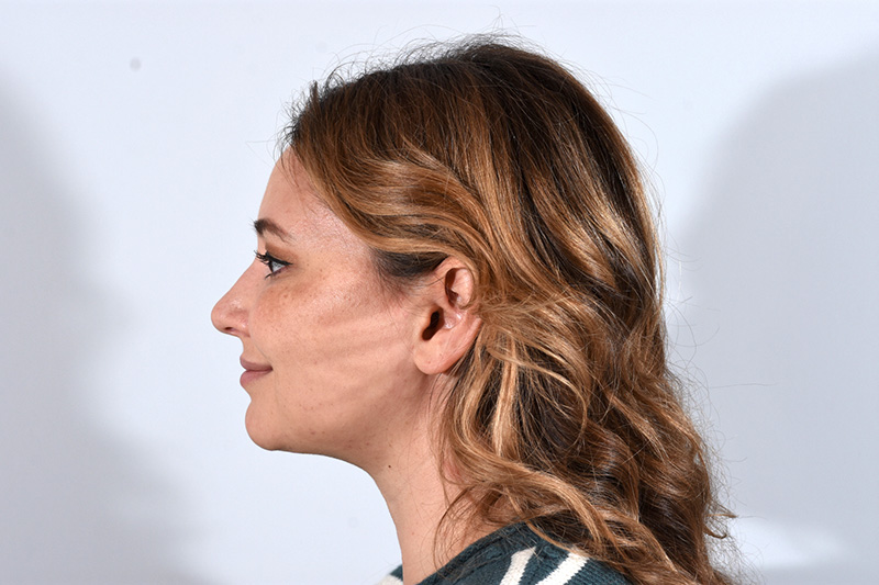 Buccal Fat Removal Before & After Image