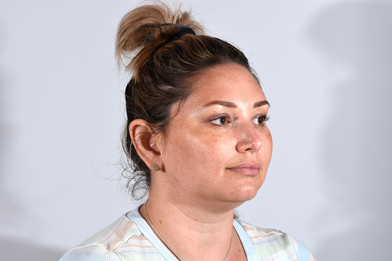Buccal Fat Removal Before & After Image