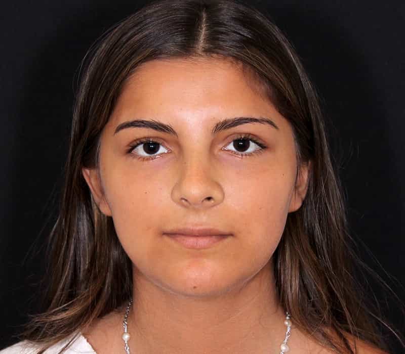 Buccal Fat Removal Before & After Photo