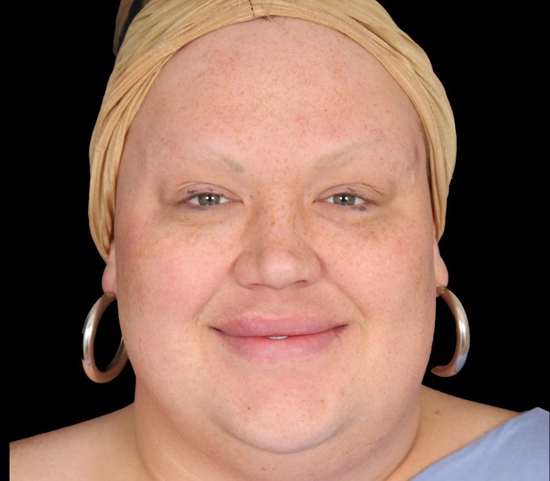 Buccal Fat Removal Before & After Photo