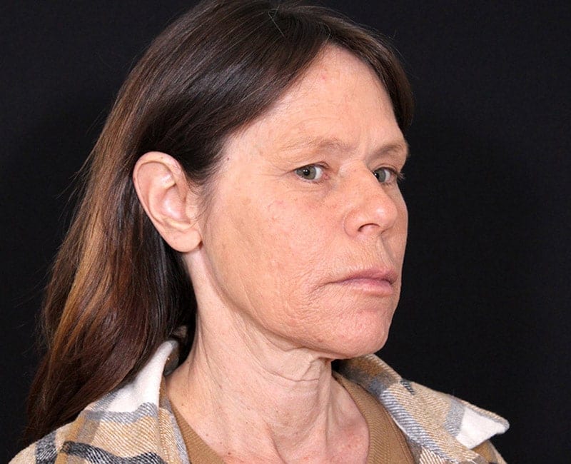 Deep Plane Facelift Before & After Photo