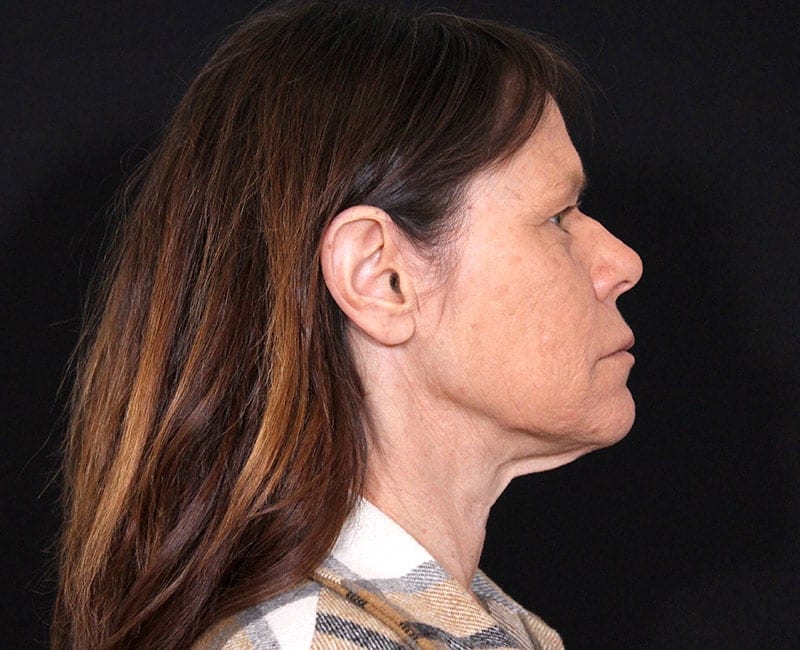 Deep Plane Facelift Before & After Image