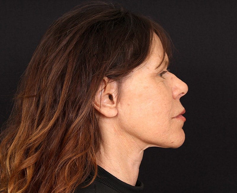 Deep Plane Facelift Before & After Image