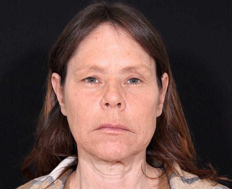 Deep Plane Facelift Before & After Image