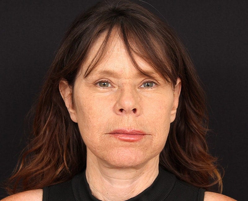 Deep Plane Facelift Before & After Image