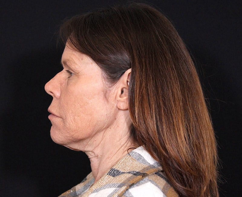 Deep Plane Facelift Before & After Image