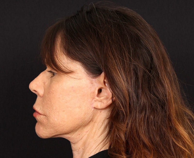 Deep Plane Facelift Before & After Image