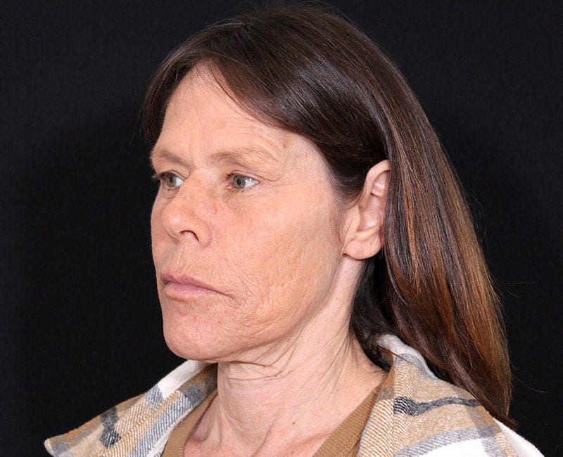 Deep Plane Facelift Before & After Image