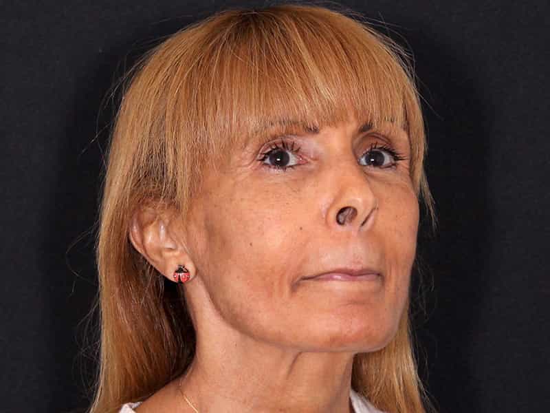 Deep Plane Facelift Before & After Photo