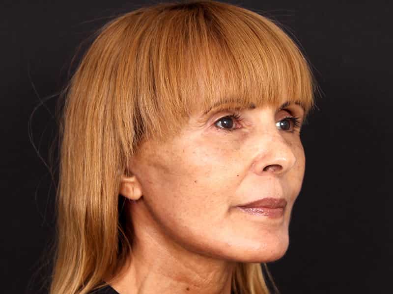 Deep Plane Facelift Before & After Photo