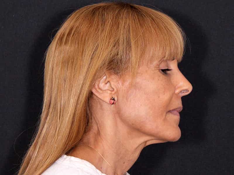 Deep Plane Facelift Before & After Image