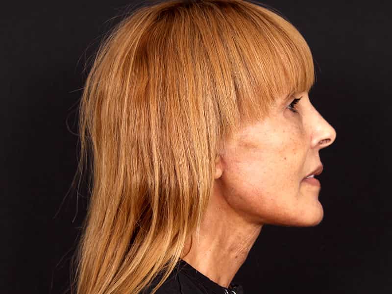 Deep Plane Facelift Before & After Image