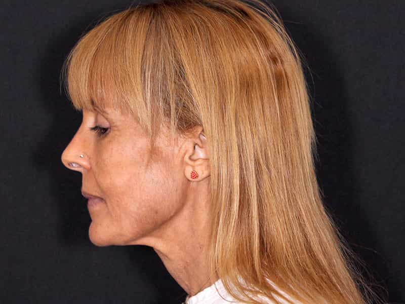Deep Plane Facelift Before & After Image