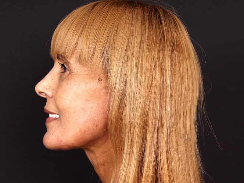 Deep Plane Facelift Before & After Image