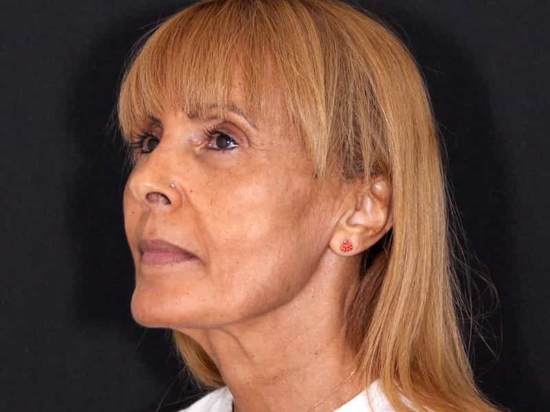 Deep Plane Facelift Before & After Image