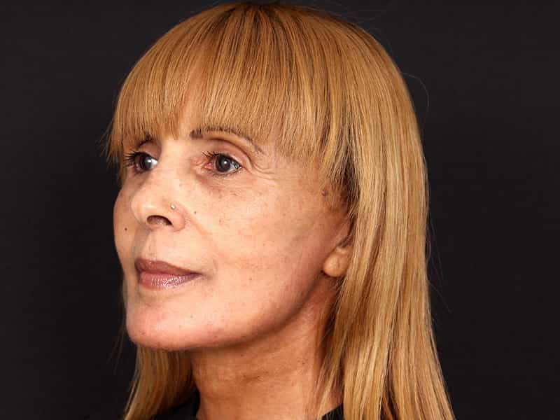 Deep Plane Facelift Before & After Image