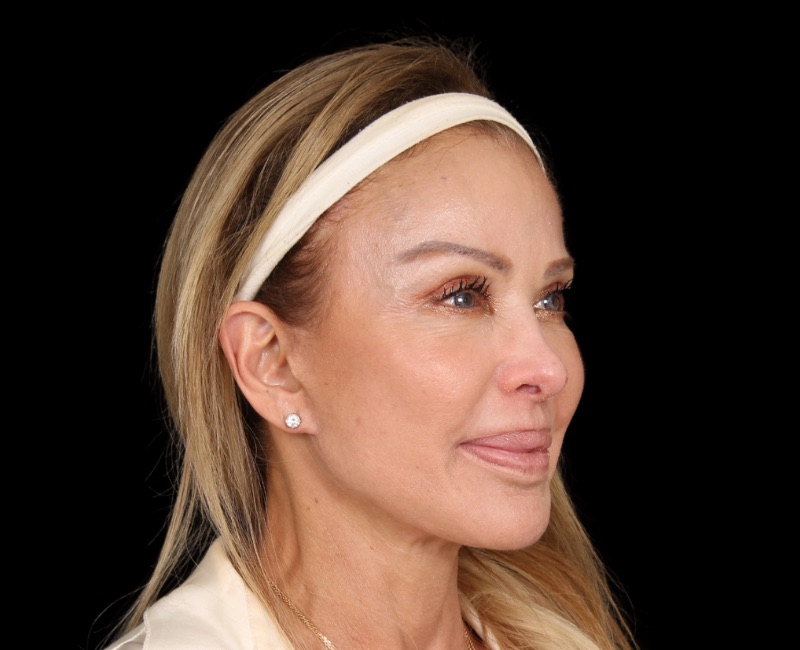 Deep Plane Facelift Before & After Photo