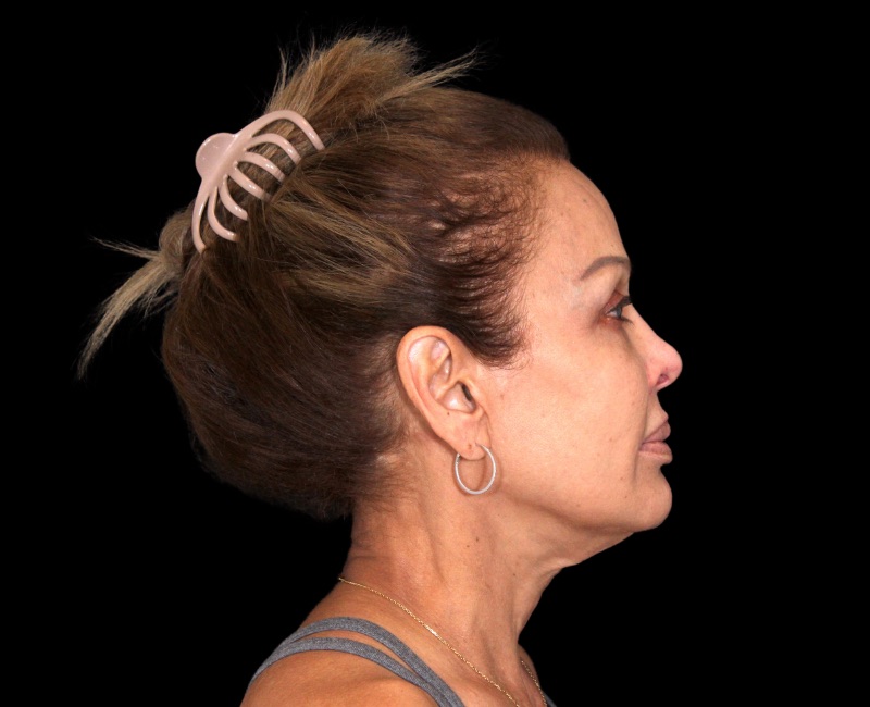 Deep Plane Facelift Before & After Image