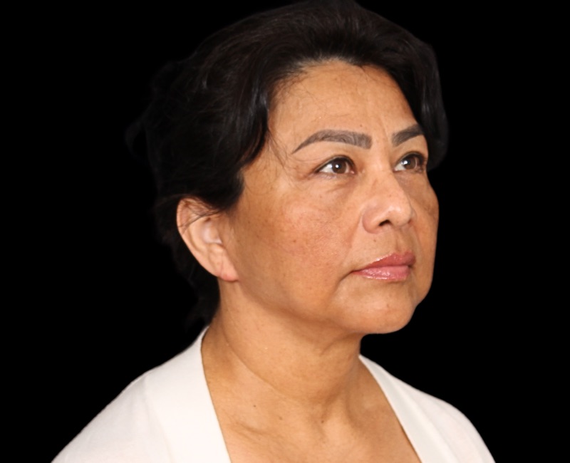 Deep Plane Facelift Before & After Photo