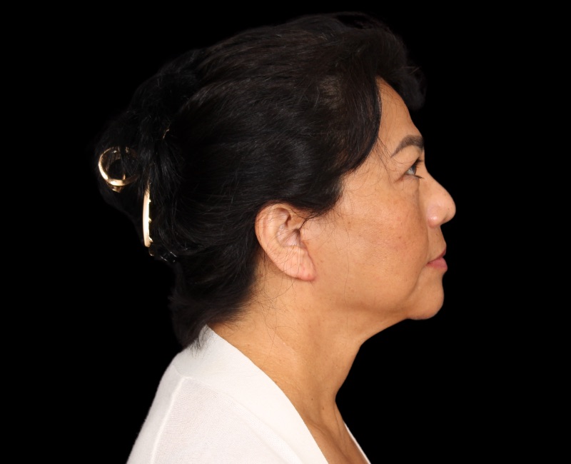 Deep Plane Facelift Before & After Image