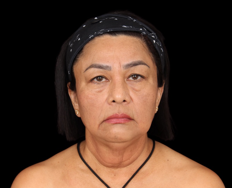 Deep Plane Facelift Before & After Image