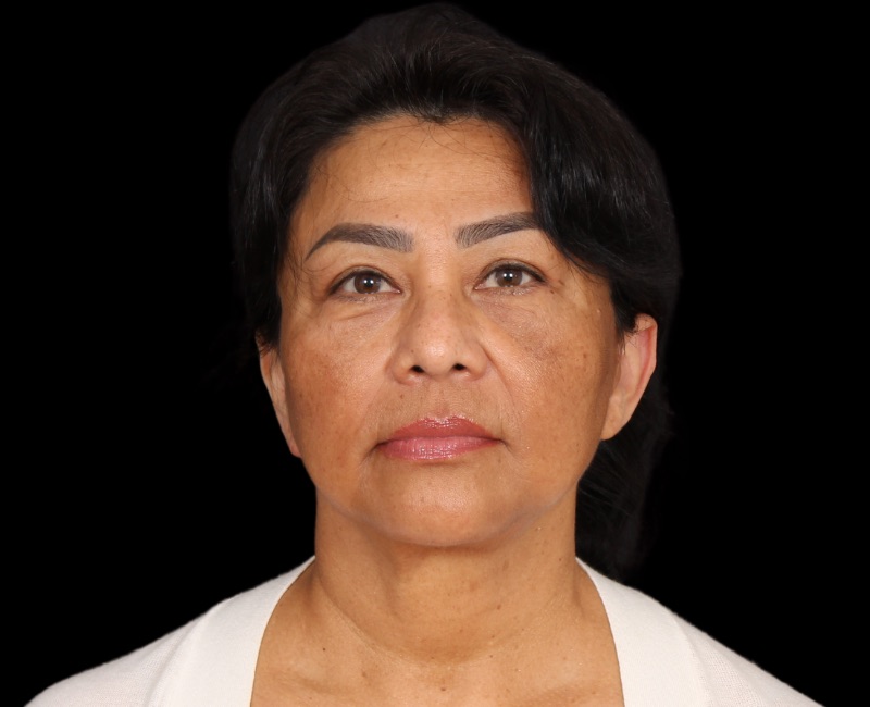 Deep Plane Facelift Before & After Image