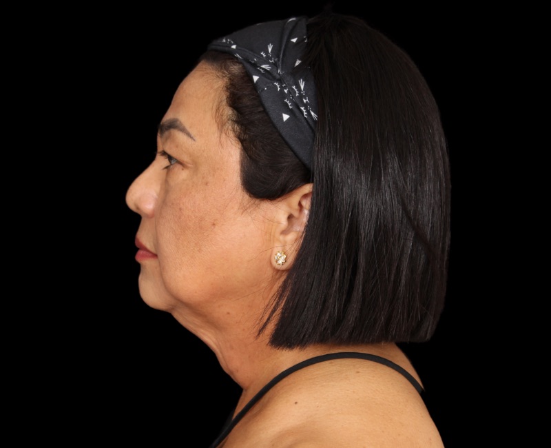 Deep Plane Facelift Before & After Image