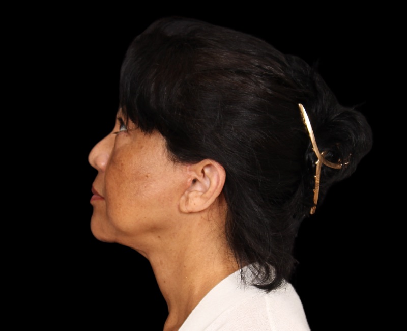 Deep Plane Facelift Before & After Image