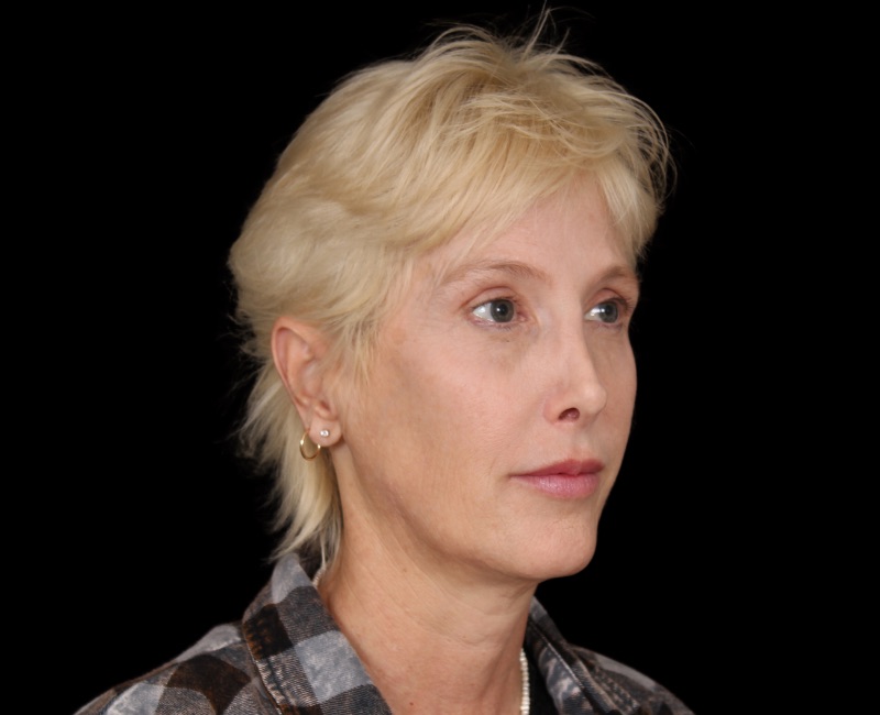 Deep Plane Facelift Before & After Photo