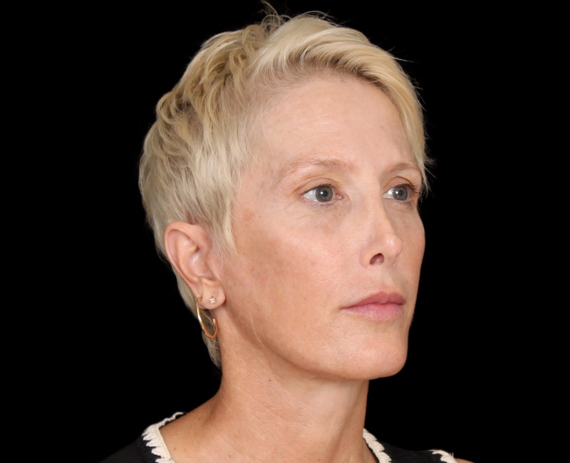 Deep Plane Facelift Before & After Photo