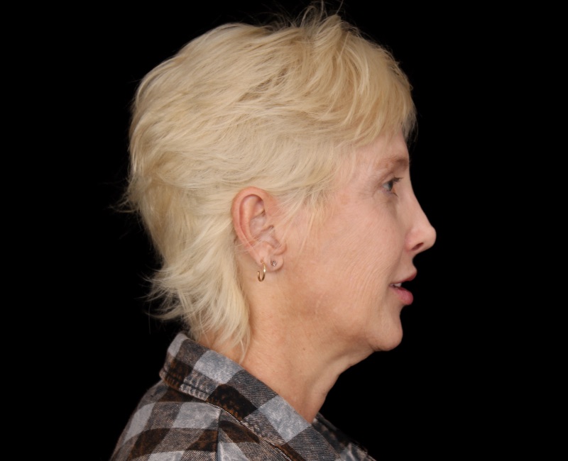 Deep Plane Facelift Before & After Image