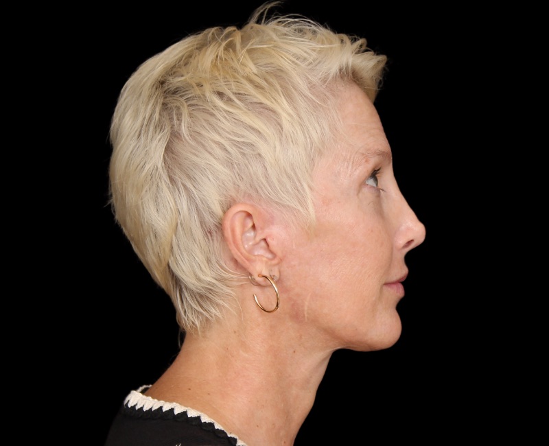 Deep Plane Facelift Before & After Image