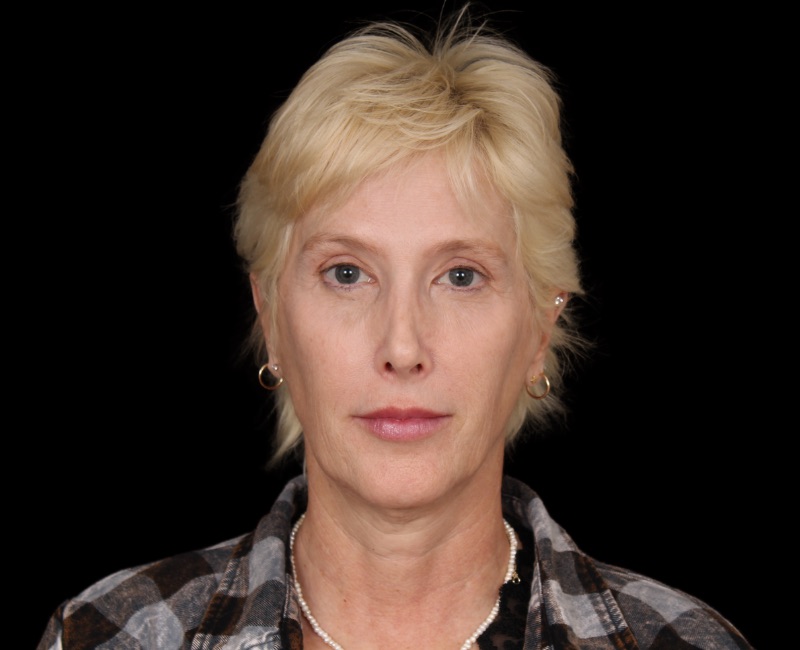 Deep Plane Facelift Before & After Image