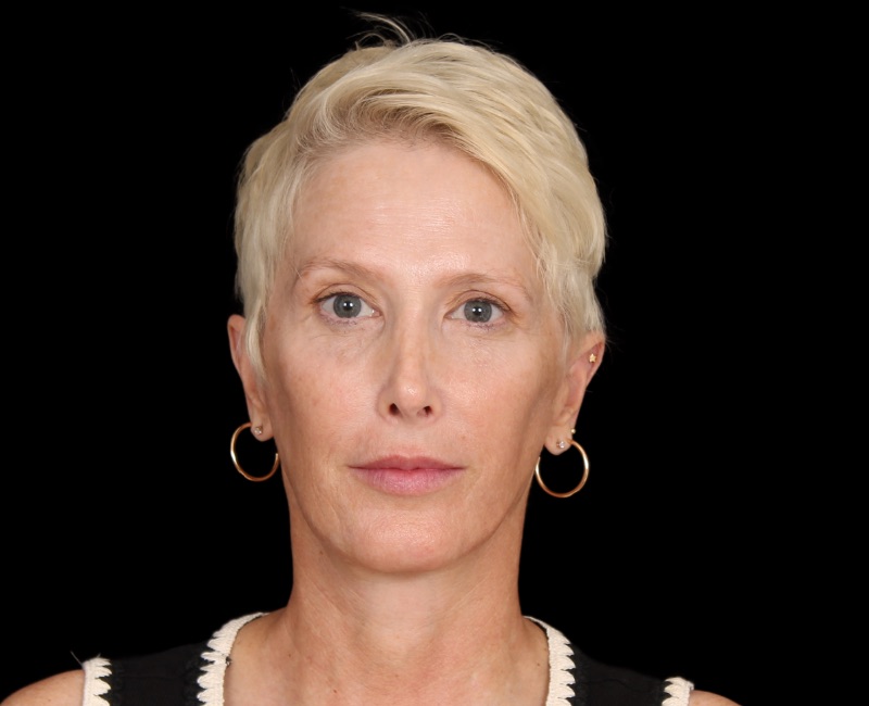 Deep Plane Facelift Before & After Image