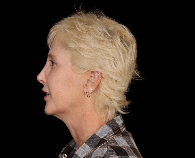 Deep Plane Facelift Before & After Image