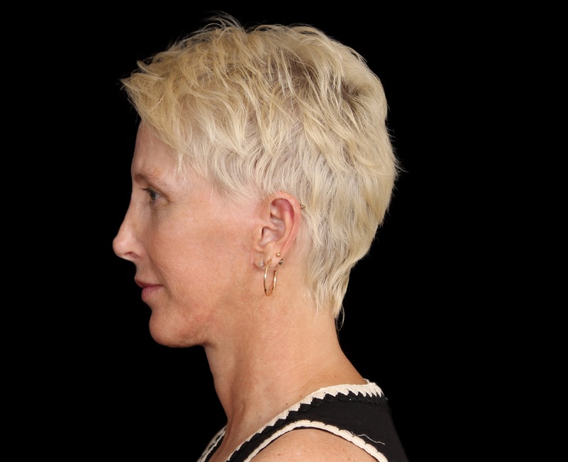 Deep Plane Facelift Before & After Image