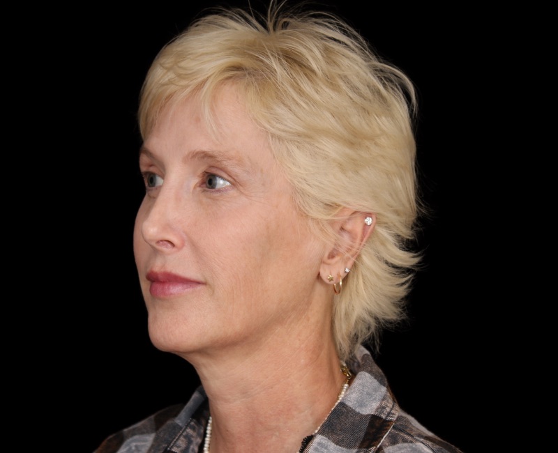 Deep Plane Facelift Before & After Image