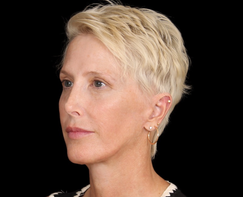 Deep Plane Facelift Before & After Image