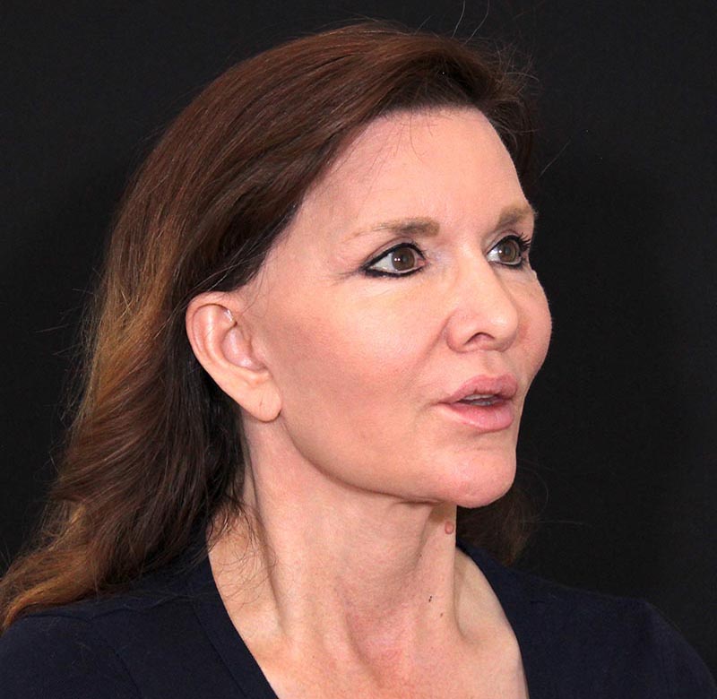 Mid Facelift Before & After Photo